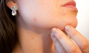 Acne Skin Treatments
